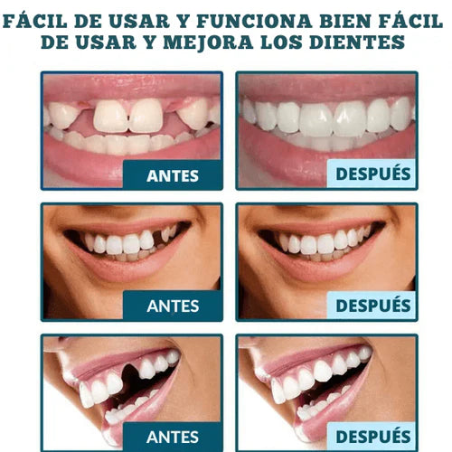 SMILEY® -SONRISA RESTAURADA EN MINUTOS - 57% OFF SOLO HOY HASTA 23:59!!!